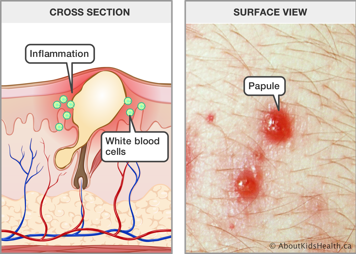 Cross section of skin with inflammation and white blood cells around sebum, and surface view of skin with papules