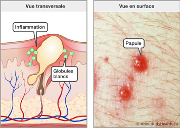 Vue transversale de la peau avec l’inflammation et les globules blancs autour du sébum et une vue en surface des papules