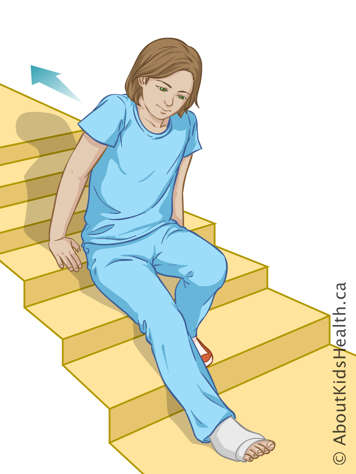 Child scooting up stairs on their bottom, using both arms and the unaffected leg