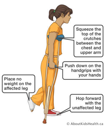 Using crutches to hop forward with the unaffected leg while placing no weight on affected leg