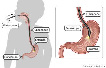 L&rsquo;emplacement de l&rsquo;&oelig;sophage, de l&rsquo;estomac et du duod&eacute;num avec l&rsquo;endoscope &agrave; travers la bouche et l&rsquo;&oelig;sophage et dans l&rsquo;estomac