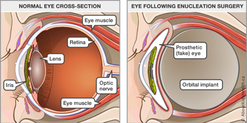 The anatomy of a normal eye and a diagram of an eye after enucleation surgery