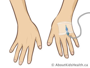 Comparing hand with IV to opposing hand