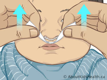 Applying tape under nose with holes in tape lined up with holes in stent