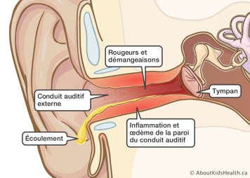 Le tympan et conduit auditif externe avec rougeurs et démangeaisons, inflammation et œdème du conduit auditif, et écoulement