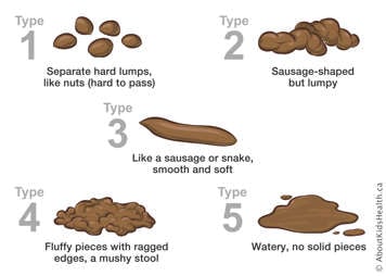 1: Hard lumps, 2: Sausage shape, lumpy, 3: Sausage shape, smooth and soft, 4: Fluffy pieces with ragged edges, 5: Watery