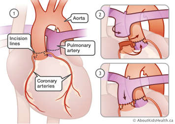 Location of aorta, pulmonary artery, coronary arteries and incision lines in an illustration of an arterial switch procedure 