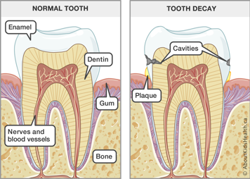 Illustration of the anatomy of a normal tooth and a tooth with decay