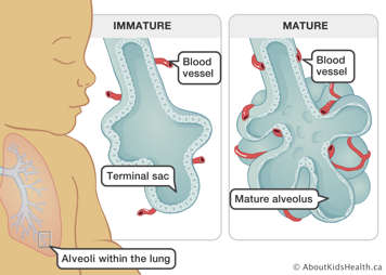 Medical illustration of immature lungs with blood vessels away from walls of terminal sac. Mature lung has mature alveolus with blood vessels wrapped around.