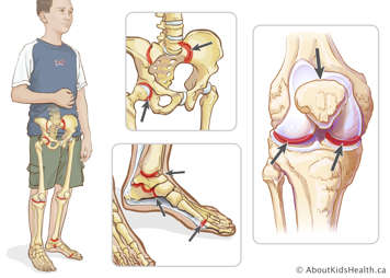 Lower joints that may be affected by ERA