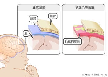 近距離示意圖：位於頭骨和大腦之間的正常腦膜，以及發炎的腦膜