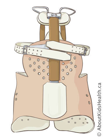 Illustration of Milwaukee body brace