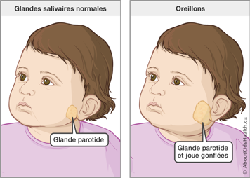 Un tout-petit avec la glande parotide ou salivaire normale et un tout-petit avec la glande parotide et la joue gonflée