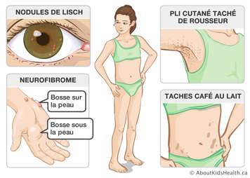 Nodules de Lisch, bosses sur et sous la peau, pli cutané taché de rousseur et taches café au lait sur le corps d’une fille