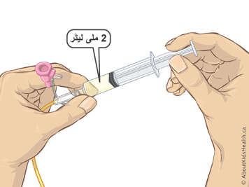  این جی ٹیوب کے ساتھ منسلک دو ملی لیٹر مائع سے بھری ہوئی سرنج