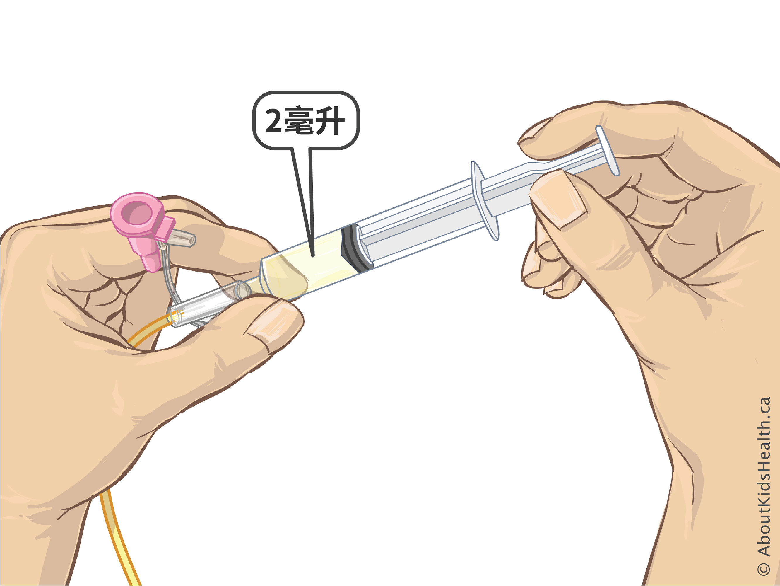 用注射器将两毫升液体注入鼻胃管
