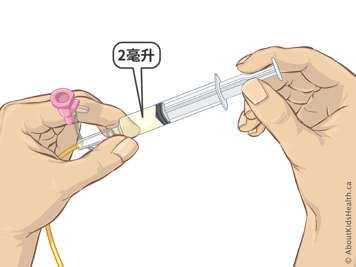 Two millilitres of liquid in a syringe attached to an NG tube
