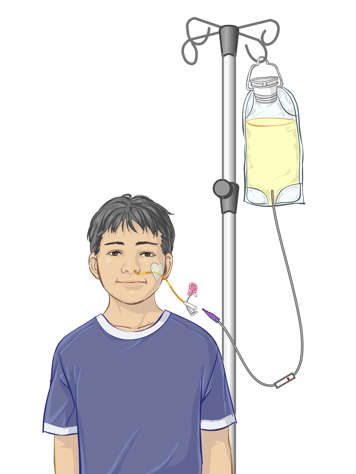 Connect tubes and roller clamp on infusion tubing for attaching a feeding bag to a child’s NG tube