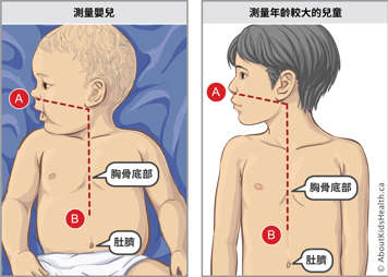 嬰兒及稍年長兒童的鼻胃管測量示意圖，以及二者胸骨底部和肚臍位置3: 在帶有兩個端口和可拆卸導線的鼻胃管上做標記