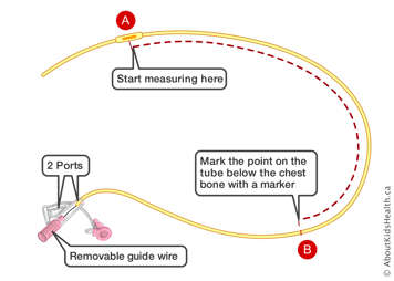 Markings on a NG tube with two ports and removable guarded wire at starting point and point on the tube below the chest bone