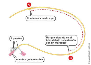 Marcas en una sonda nasogástrica con dos puertos y cable guía desmontable