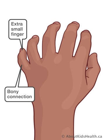 Duplicated small finger with a bony connection