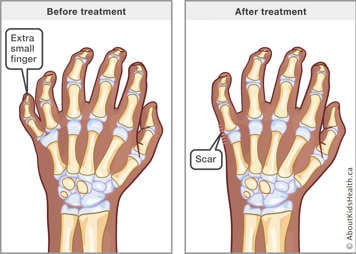 Before and after illustration for surgical removal of an extra small finger with a bony connection