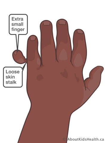 Duplicated small finger loosely connected by skin