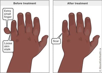 Before and after illustration for surgical removal of an extra small finger connected by a loose stalk