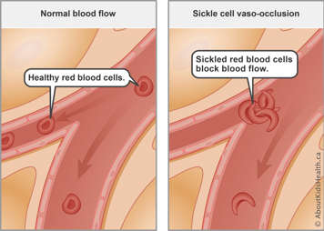 Normal blood flow with healthy red blood cells compared to blocked blood flow from sickled red blood cells