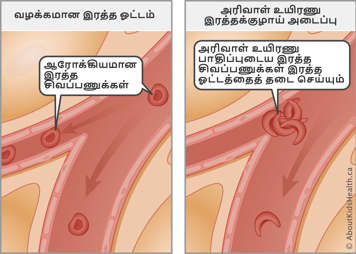 Normal blood flow with healthy red blood cells compared to blocked blood flow from sickled red blood cells