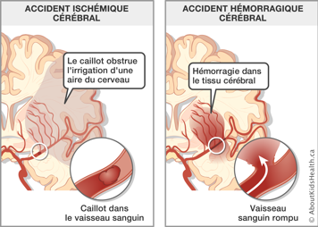 Un cerveau touché par un accident ischémique cérébral et un cerveau touché par un accident hémorragique cérébral