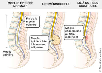 Une moelle épinière normale, une moelle épinière liée à une masse adipeuse et une moelle épinière liée au tissue cicatriciel