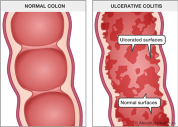 Close-up of normal colon and close-up of colon with ulcerative colitis