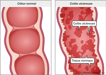 Gros plan sur un côlon normal et gros plan sur un côlon avec colite ulcéreuse