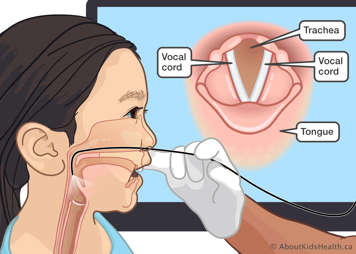 Medical illustration of a gloved hand passing thin tube through a child's nose into the throat to see vocal cords and trachea