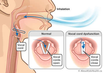 Medical illustration of vocal cords during inhalation. In VCD or EILO, the vocal cords snap closed during inhalation
