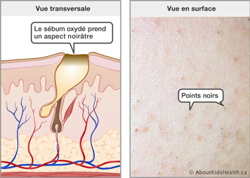 Vue transversale de la peau avec un sébum oxydé causant un aspect noirâtre à la surface et la vue en surface des points noirs