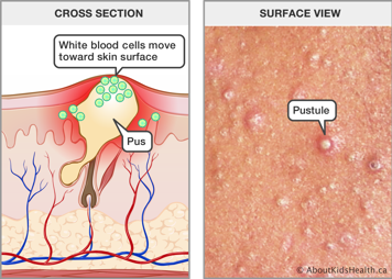 Cross section of pus under the skin and white blood cells that have moved toward the surface, and surface view of pustules