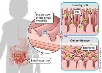 Location of the small intestine in the body shown with a side by side comparison of healthy villi versus flattened villi that is typically seen with celiac disease