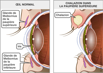 Les glandes de Meibomius des paupières d’un œil normal et un œil avec un chalazion dans la paupière supérieure