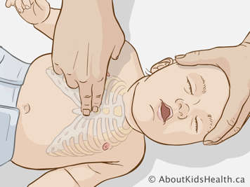 Performing chest compressions on baby