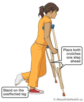 Standing on the unaffected leg and placing both crutches one step ahead