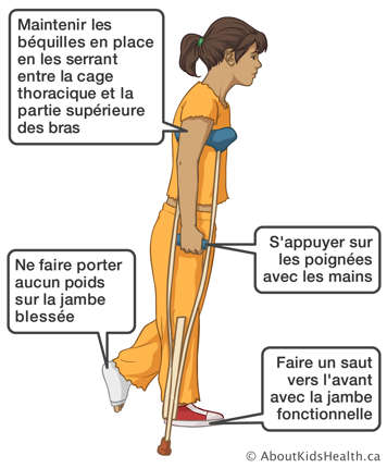 Faisant un saut vers l’avant avec la jambe fonctionnelle à l’aide des béquilles, ne portant aucun poids sur la jambe blessée