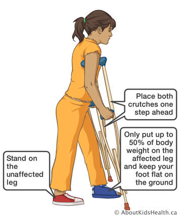 Using crutches to step ahead with up to 50% of body weight on the affected leg and keep foot flat on the ground