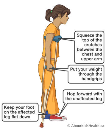 Using crutches to hop forward with the unaffected leg while keeping foot of affected leg flat down