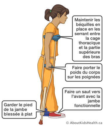 Faisant un saut vers l’avant avec la jambe fonctionnelle en gardant le pied de la jambe blessée à plat à l’aide des béquilles