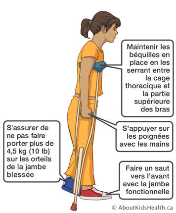 Faisant un saut vers l’avant avec jambe fonctionnelle à l’aide des béquilles sans porter plus de dix poids sur jambe blessée