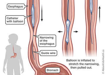 An esophageal dilatation.