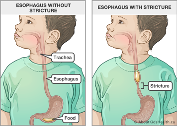 Esophagus without stricture and esophagus with stricture